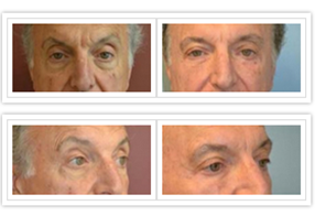 Eyelid Surgery Before and After Pictures Philadelphia, PA