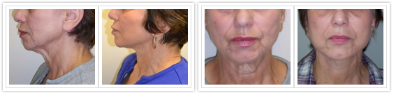 Facelift Before and After Pictures Philadelphia, PA