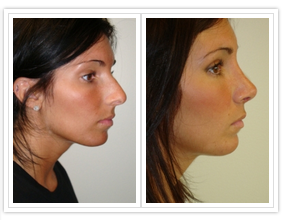 Rhinoplasty Before and After Pictures Philadelphia, PA