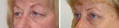 Eyelid Surgery Before and After Pictures Philadelphia, PA