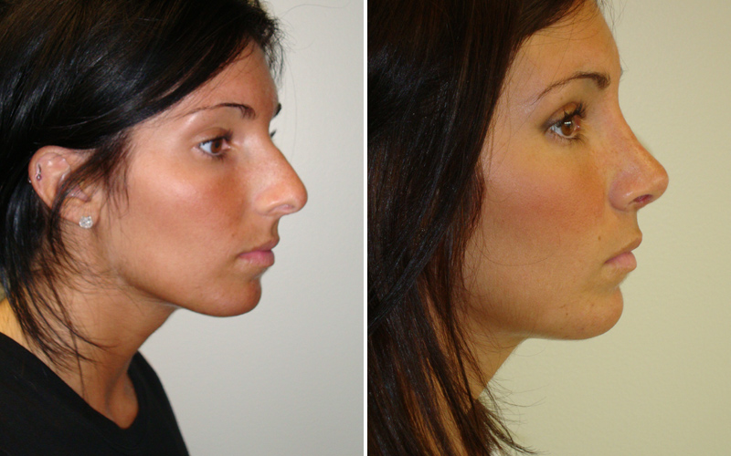 causes and effects of plastic surgery essay causes and effects of plastic surgery essay