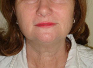 Facelift Before and After Pictures Philadelphia, PA