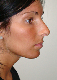 Rhinoplasty Before and After Pictures Philadelphia, PA