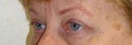 Eyelid Surgery Before and After Pictures Philadelphia, PA