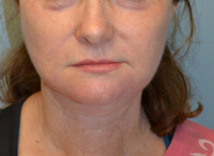 Facelift Before and After Pictures Philadelphia, PA