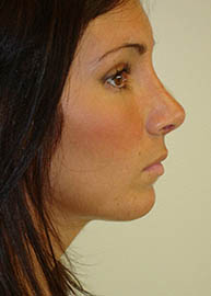 Rhinoplasty Before and After Pictures Philadelphia, PA