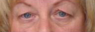 Eyelid Surgery Before and After Pictures Philadelphia, PA