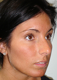 Rhinoplasty Before and After Pictures Philadelphia, PA