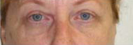 Eyelid Surgery Before and After Pictures Philadelphia, PA