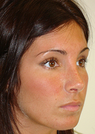 Rhinoplasty Before and After Pictures Philadelphia, PA