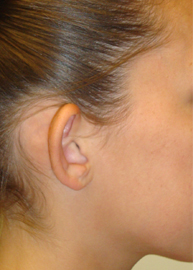 Ear Surgery Before and After Pictures Philadelphia, PA