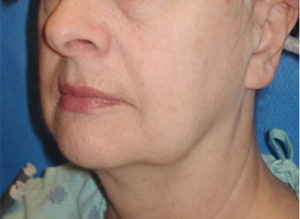 Facelift Before and After Pictures Philadelphia, PA