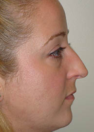 Rhinoplasty Before and After Pictures Philadelphia, PA