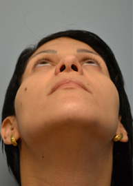 Revision Rhinoplasty Before and After Pictures Philadelphia, PA