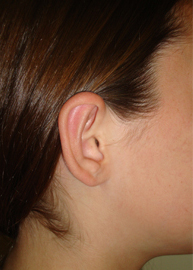 Ear Surgery Before and After Pictures Philadelphia, PA