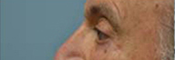 Eyelid Surgery Before and After Pictures Philadelphia, PA
