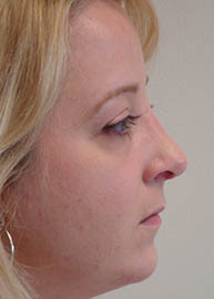 Rhinoplasty Before and After Pictures Philadelphia, PA