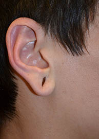 Ear Surgery Before and After Pictures Philadelphia, PA