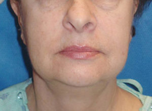 Facelift Before and After Pictures Philadelphia, PA