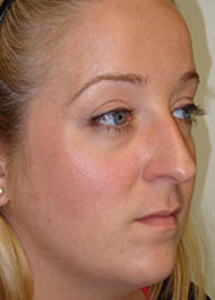 Rhinoplasty Before and After Pictures Philadelphia, PA