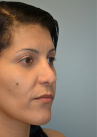 Revision Rhinoplasty Before and After Pictures Philadelphia, PA