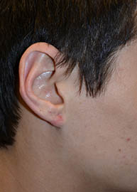 Ear Surgery Before and After Pictures Philadelphia, PA