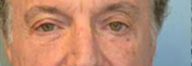 Eyelid Surgery Before and After Pictures Philadelphia, PA