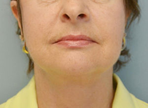 Facelift Before and After Pictures Philadelphia, PA