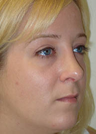 Rhinoplasty Before and After Pictures Philadelphia, PA