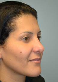 Revision Rhinoplasty Before and After Pictures Philadelphia, PA