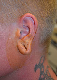 Ear Surgery Before and After Pictures Philadelphia, PA
