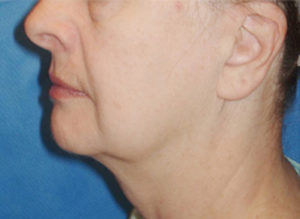 Facelift Before and After Pictures Philadelphia, PA