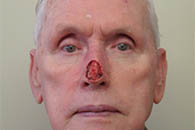 Facial Reconstruction Before and After Pictures Philadelphia, PA