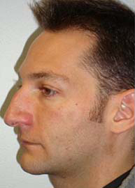 Rhinoplasty Before and After Pictures Philadelphia, PA