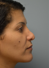 Revision Rhinoplasty Before and After Pictures Philadelphia, PA