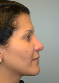 Revision Rhinoplasty Before and After Pictures Philadelphia, PA