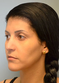 Revision Rhinoplasty Before and After Pictures Philadelphia, PA