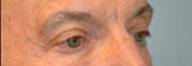 Eyelid Surgery Before and After Pictures Philadelphia, PA