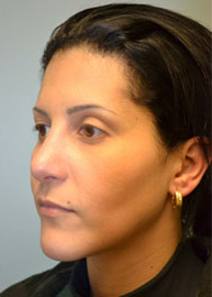 Revision Rhinoplasty Before and After Pictures Philadelphia, PA