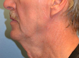 Facelift Before and After Pictures Philadelphia, PA