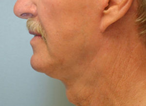 Facelift Before and After Pictures Philadelphia, PA