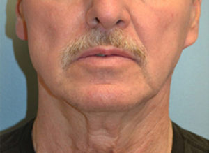 Facelift Before and After Pictures Philadelphia, PA