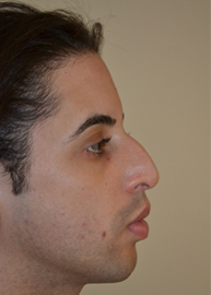 Rhinoplasty Before and After Pictures Philadelphia, PA