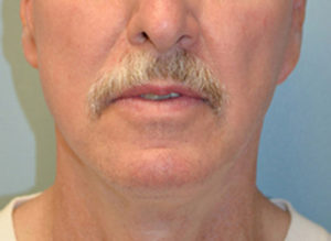 Facelift Before and After Pictures Philadelphia, PA