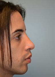 Rhinoplasty Before and After Pictures Philadelphia, PA