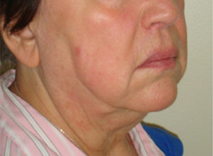 Facelift Before and After Pictures Philadelphia, PA