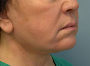 Facelift Before and After Pictures Philadelphia, PA