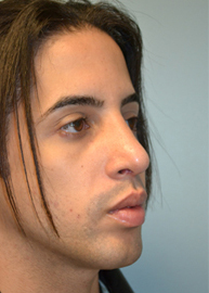 Rhinoplasty Before and After Pictures Philadelphia, PA