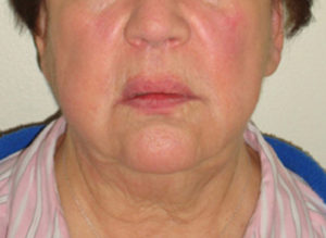 Facelift Before and After Pictures Philadelphia, PA