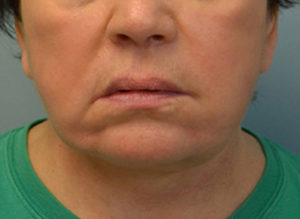 Facelift Before and After Pictures Philadelphia, PA